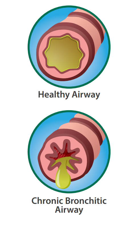 Healthy Airway vs. Chronic Bronchitic Airway