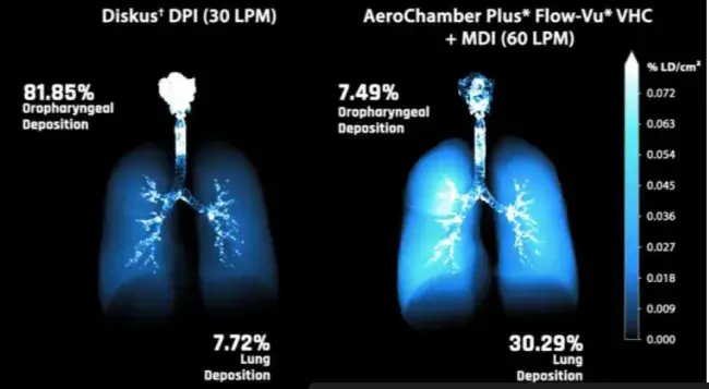 A Comparison, Using Functional Respiratory Imaging (FRI), of Adult Airway Deposition Profiles from a Pressurized Metered Dose Inhaler with Valved Holding Chamber ( pMDI /VHC) and Two Dry Powder Inhalers (DPI)