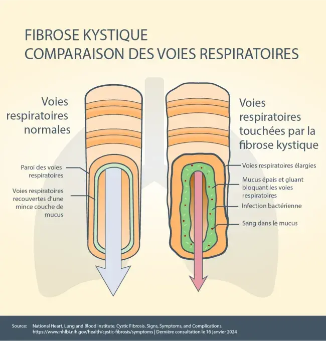 fibrose kystique comparaison des voies respiratoires