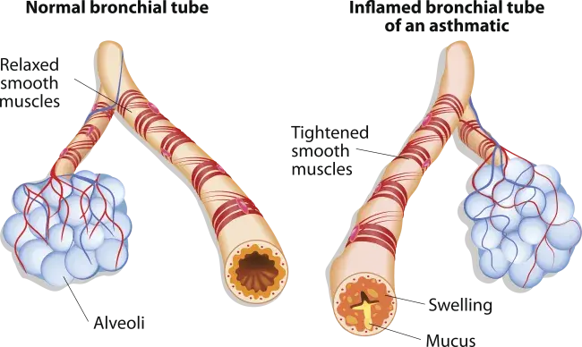 diagram depicting normal bronchial tube next to inflamed bronchial tube of an asthmatic