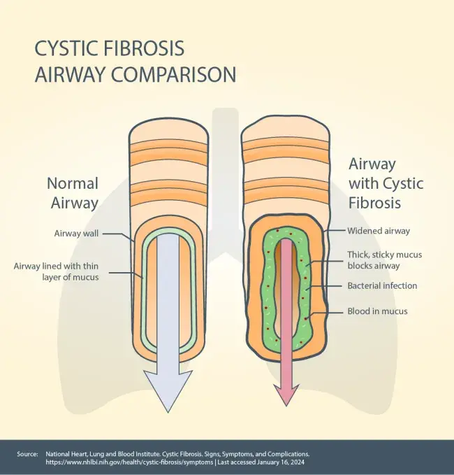 diagram showing comparison of normal airway versus airway with cystic fibrosis