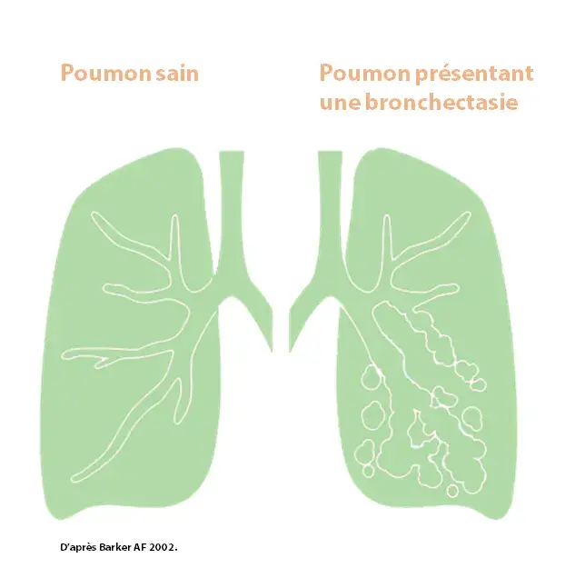 Living with bronch - FR