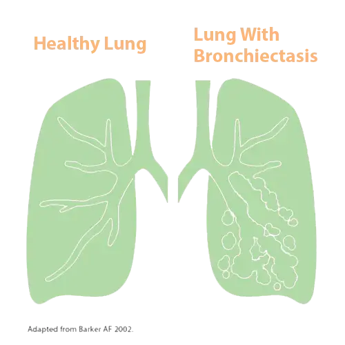 healthy lung vs lung with bronchiectasis